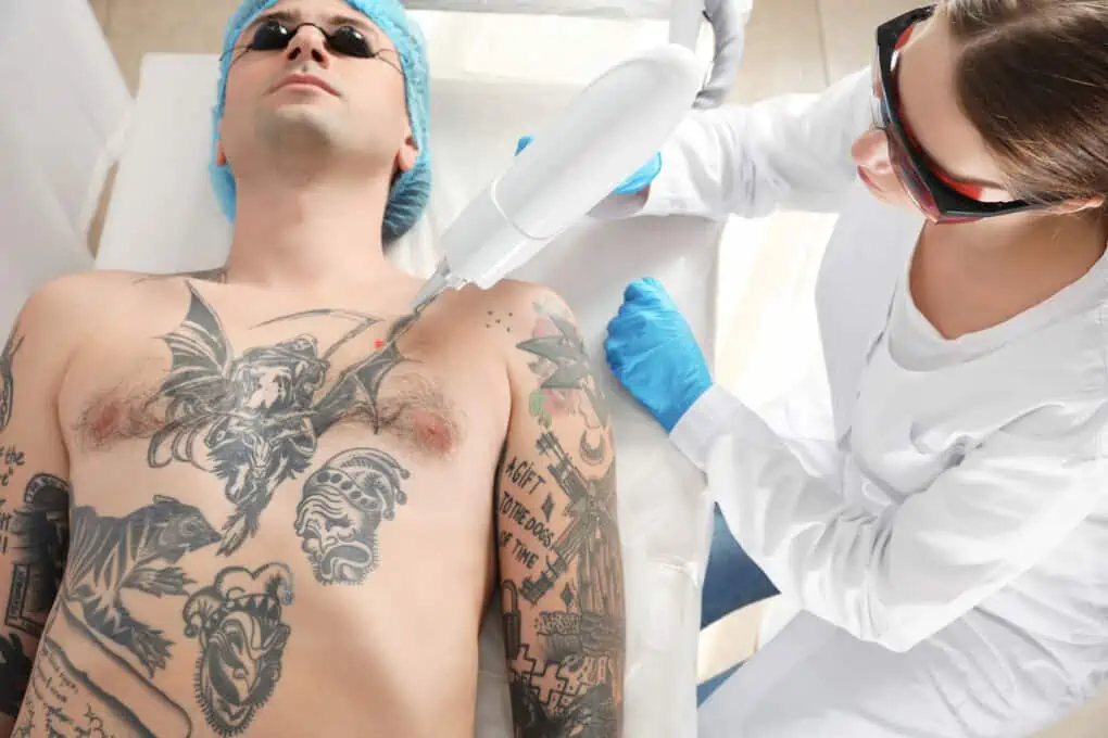 tattoo removal chest