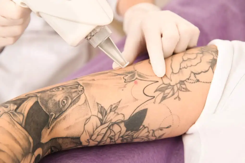 tattoo removal arm bern