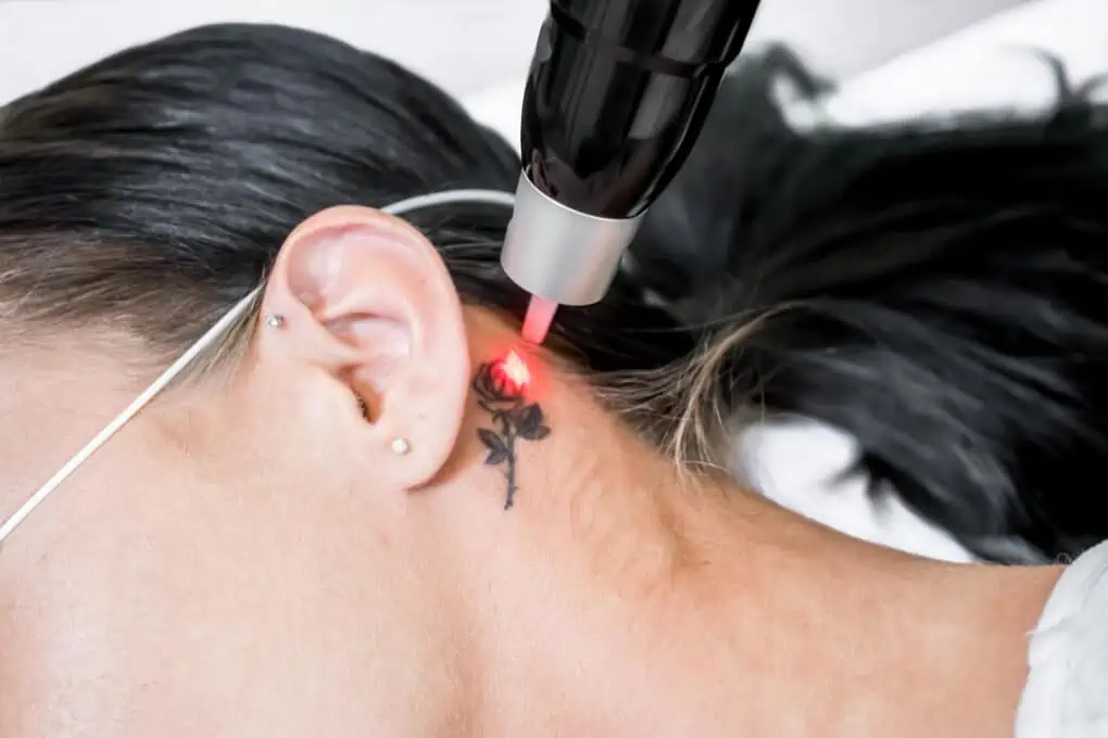 tattoo removal ear
