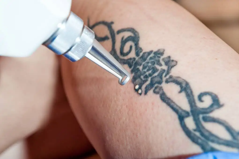 tattoo removal close up